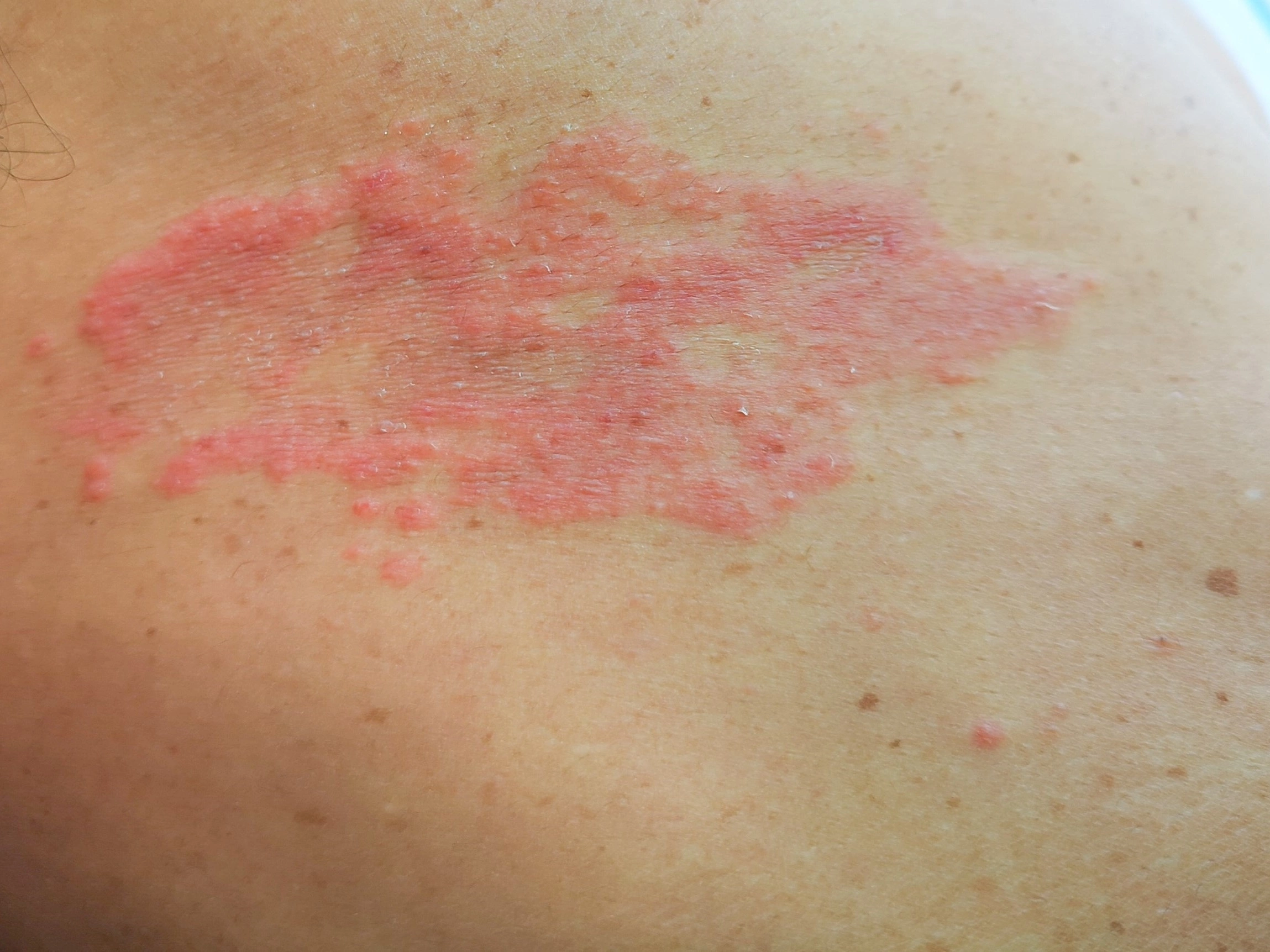 Zona thần kinh - Yếu tố nguy cơ thường gặp